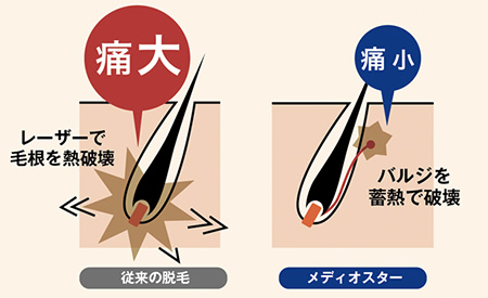 従来の脱毛とメディオスターNeXT PROの違い